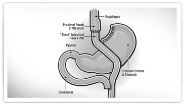 Gastric bypass illustration 
