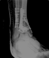 x-ray of the broken bone being healed
