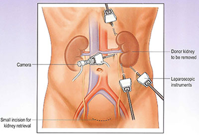 graphic of kidney surgery
