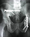 x-ray of a pelvis with pins