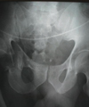 x-ray of a traumatic pelvic fracture