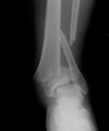 x-ray of a severely fractured bone