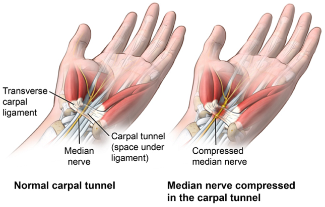 medical diagram: a hand with carpal tunnel syndrome